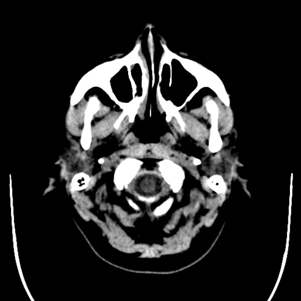Calvarial osteoma (Radiopaedia 36520-38079 Axial non-contrast 4).jpg