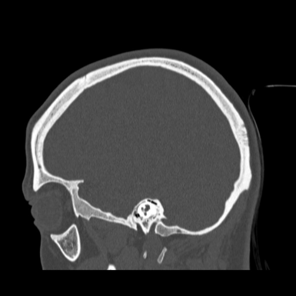 Calvarial osteoma (Radiopaedia 36520-38079 Sagittal bone window 33).jpg