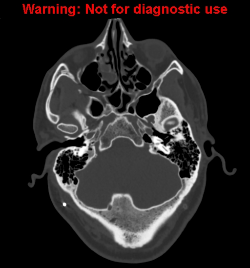 Calvarial thickening from chronic shunting (Radiopaedia 60079-67637 Axial bone window 32).jpg