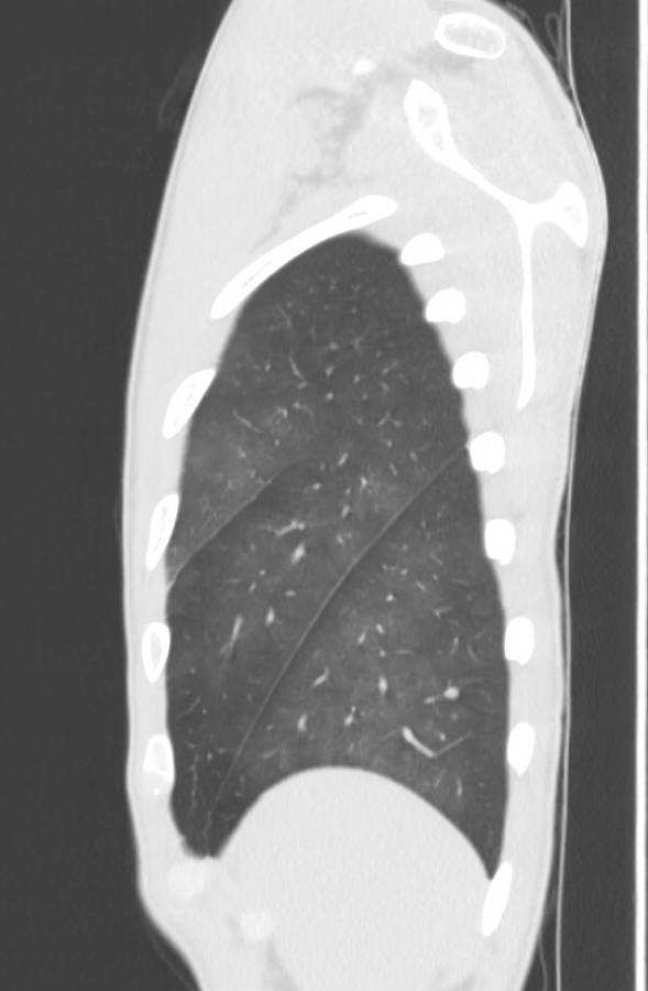 Cannabis-induced diffuse alveolar hemorrhage (Radiopaedia 89834-106946 Sagittal lung window 125).jpg