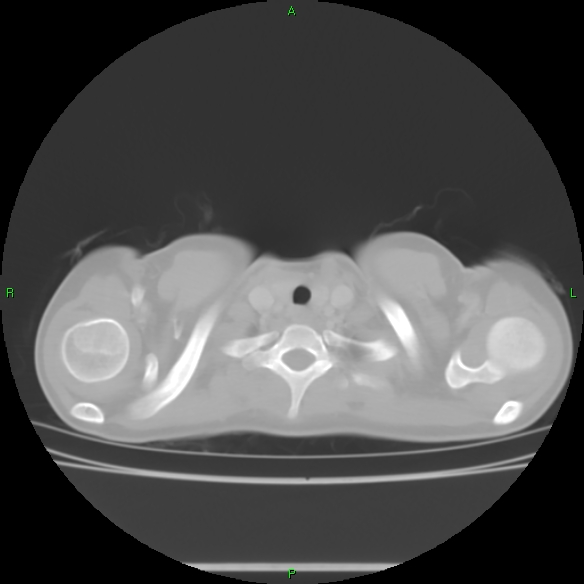 File:Cannon ball metastases - synovial sarcoma (Radiopaedia 26135-26271 Axial lung window 3).jpg