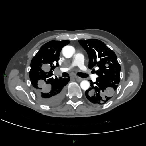 Cannonball metastases (Radiopaedia 82110-96150 Axial C+ CTPA 149).jpg