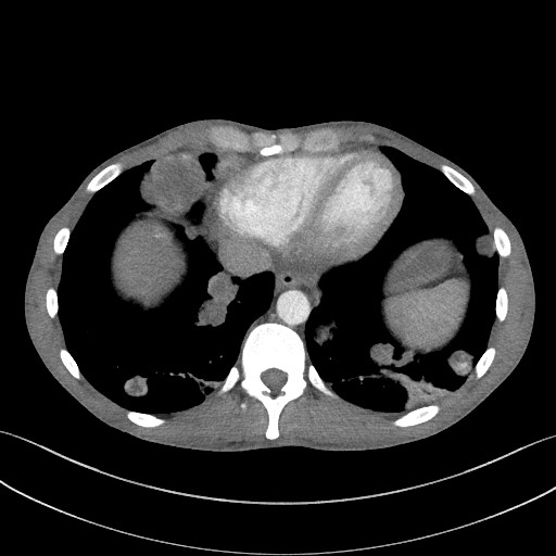 Cannonball metastases - testicular choriocarcinoma (Radiopaedia 84510-99891 B 86).jpg