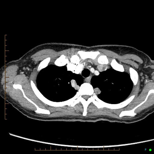 Canonball lung metastasis (Radiopaedia 77634-89837 B 13).jpg