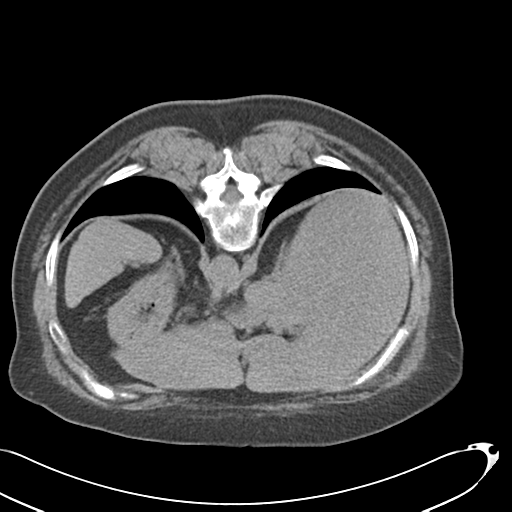 File:Carcinoid tumor - lung (Radiopaedia 44814-48644 Axial non-contrast 27).png