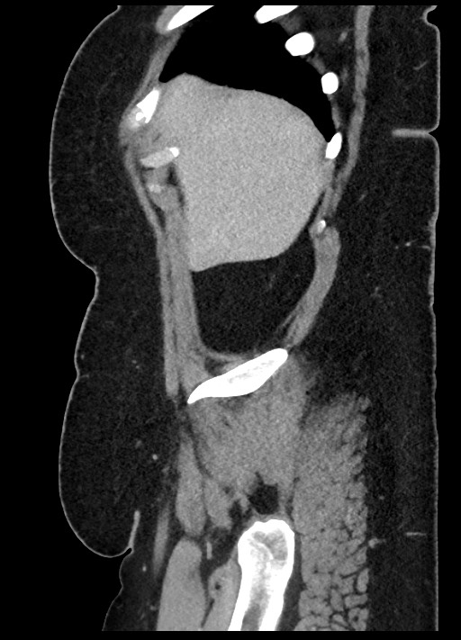 Carcinoid tumor - terminal ileum (Radiopaedia 60931-68739 C 92).jpg
