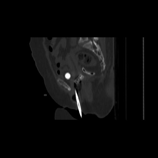 File:Carcinoma cervix- brachytherapy applicator (Radiopaedia 33135-34173 Sagittal bone window 78).jpg