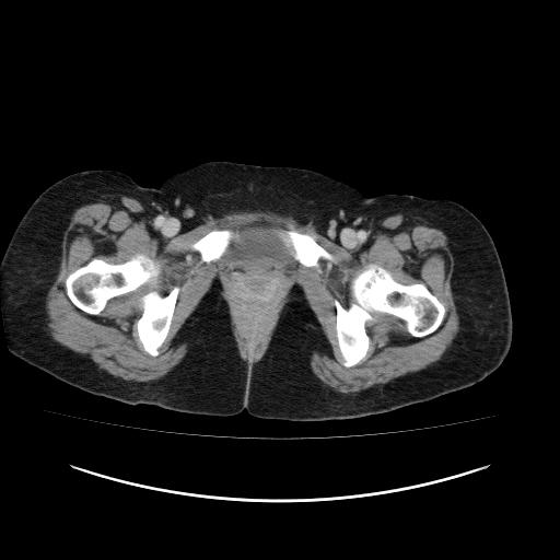 File:Carcinoma colon - hepatic flexure (Radiopaedia 19461-19493 A 130).jpg