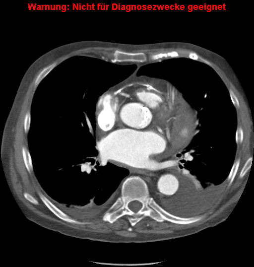 File:Cardiac perforation following transcatheter aortic valve implantation (Radiopaedia 23714-23863 A 3).png