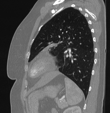 Cardiac sarcoidosis (Radiopaedia 74548-85534 Sagittal lung window 23).jpg