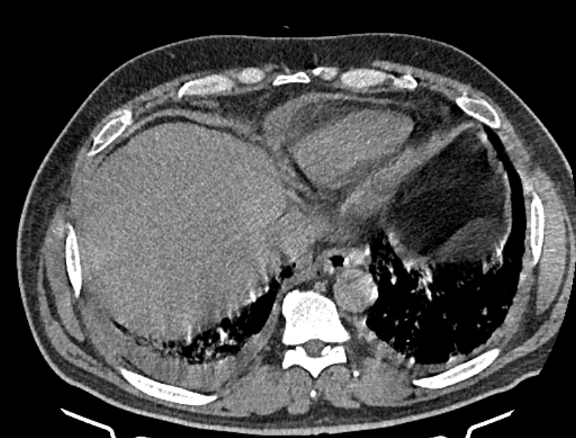 Cardiogenic pulmonary edema (Radiopaedia 68180-77678 Axial non-contrast 44).jpg