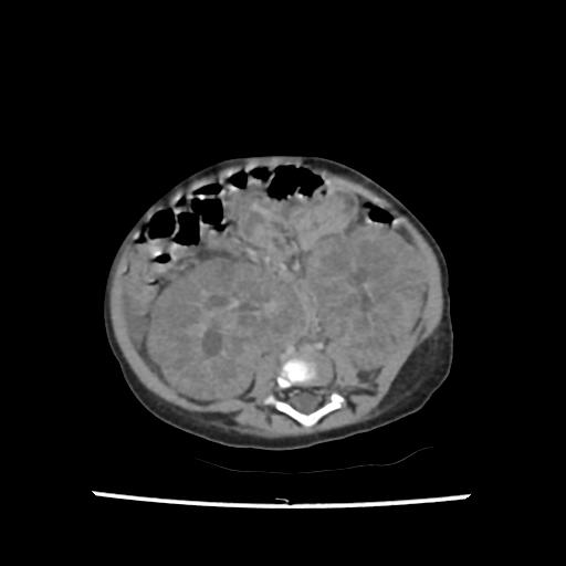 Caroli disease with autosomal recessive polycystic kidney disease (ARPKD) (Radiopaedia 89651-106703 B 146).jpg