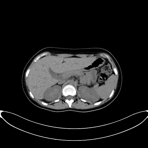 Caroli disease with medullary sponge kidney (Radiopaedia 82622-96804 Axial non-contrast 23).jpg