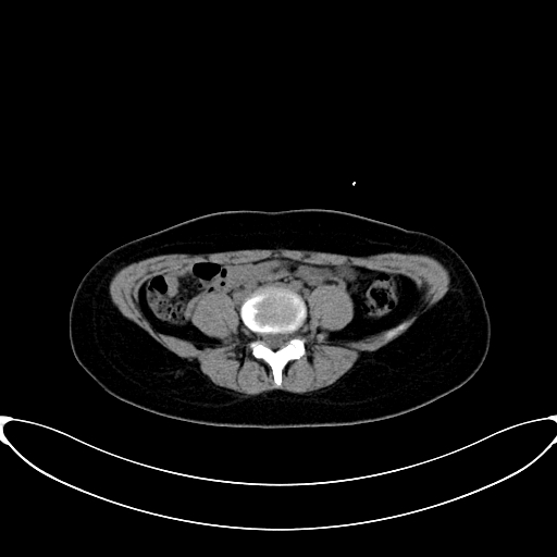 Caroli disease with medullary sponge kidney (Radiopaedia 82622-96804 Axial non-contrast 48).jpg
