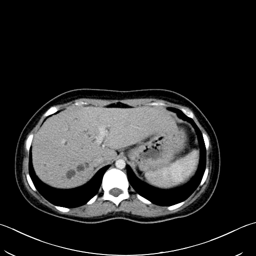 Caroli disease with medullary sponge kidney (Radiopaedia 82622-96804 C 17).jpg