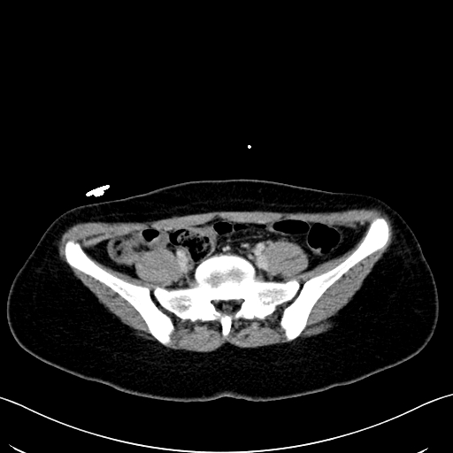 Caroli disease with medullary sponge kidney (Radiopaedia 82622-96804 C 54).jpg