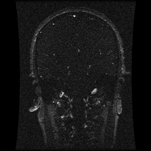 Carotid arterial dissection with acute cerebral infarction (Radiopaedia 26636-26784 MRV 87).jpg