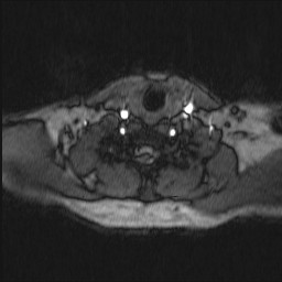 Carotid artery dissection (Radiopaedia 28441-28689 Axial MRA 18).jpg