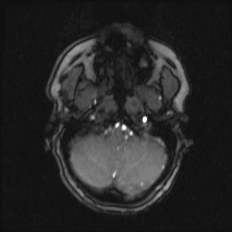 Carotid artery dissection (Radiopaedia 28441-28689 Axial MRA 63).jpg