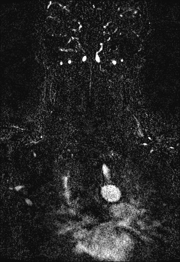 Carotid artery dissection (Radiopaedia 28441-28689 Coronal MRA 71).jpg