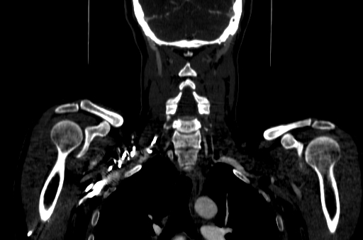 File:Carotid bulb pseudoaneurysm (Radiopaedia 57670-64616 D 65).jpg