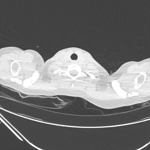 Catamenial pneumothorax (Radiopaedia 27946-28197 lung window 10).jpg