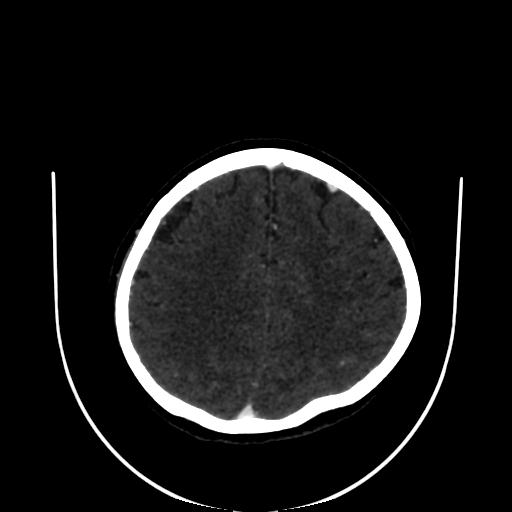 Cavernoma with developmental venous anomaly (Radiopaedia 22470-22506 C 137).jpg