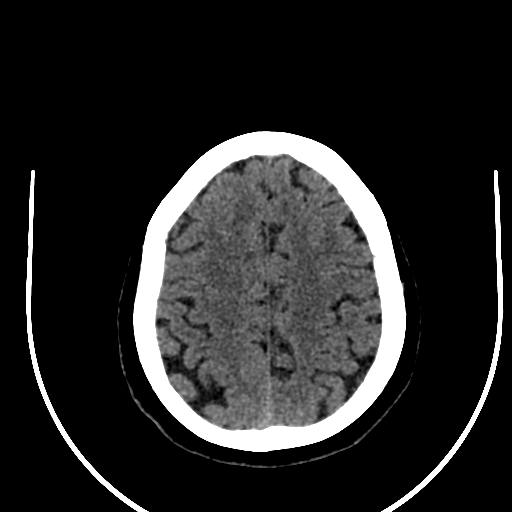 Cavernous hemangioma of the cerebellar falx (Radiopaedia 73025-83723 Axial non-contrast 106).jpg