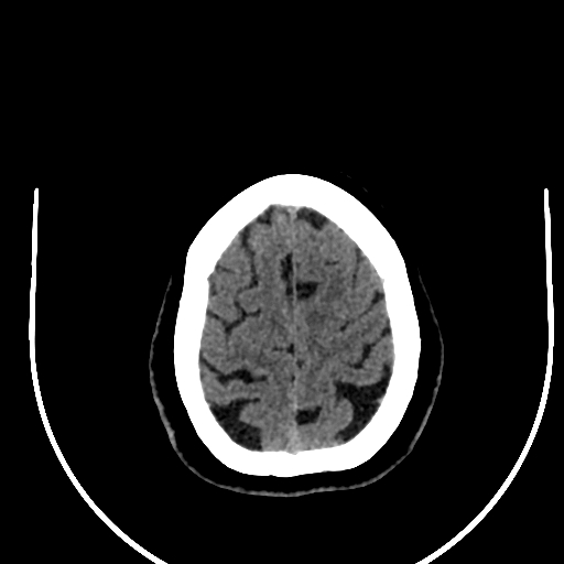 Cavernous hemangioma of the cerebellar falx (Radiopaedia 73025-83723 Axial non-contrast 118).jpg