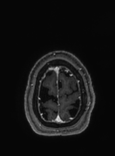 Cavernous hemangioma of the cerebellar falx (Radiopaedia 73025-83724 Axial T1 C+ 37).jpg