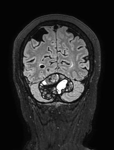 Cavernous hemangioma of the cerebellar falx (Radiopaedia 73025-83724 Coronal FLAIR 295).jpg