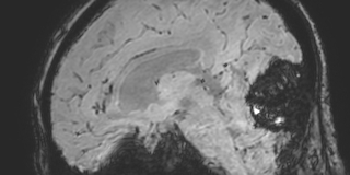 Cavernous hemangioma of the cerebellar falx (Radiopaedia 73025-83724 Sagittal BOLD 94).jpg