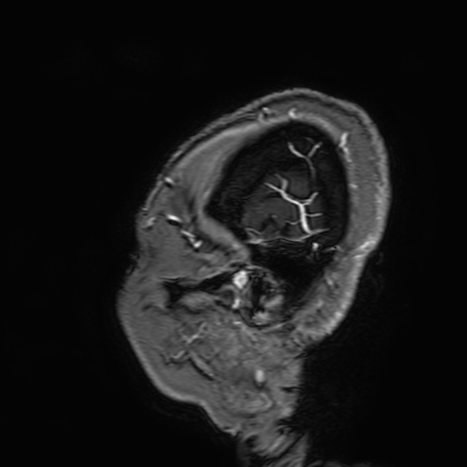 File:Cavernous hemangioma of the cerebellar falx (Radiopaedia 73025-83724 Sagittal T1 C+ 13).jpg
