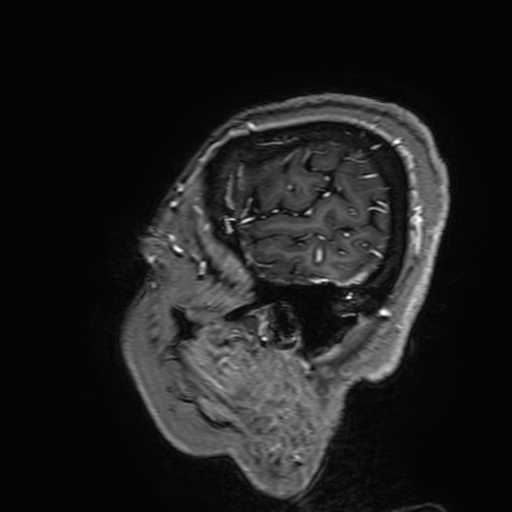 File:Cavernous hemangioma of the cerebellar falx (Radiopaedia 73025-83724 Sagittal T1 C+ 191).jpg