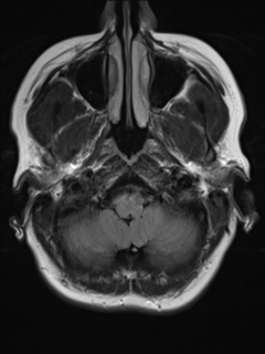 File:Cavernous malformation (cavernous angioma or cavernoma) (Radiopaedia 36675-38237 Axial T2 FLAIR 2).png