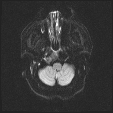 Cavernous sinus meningioma (Radiopaedia 63682-72367 DWI 24).jpg
