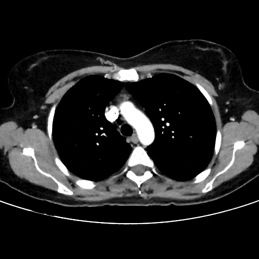 File:Cavitating lung mass - squamous cell carcinoma (Radiopaedia 48047-52854 B 16).png