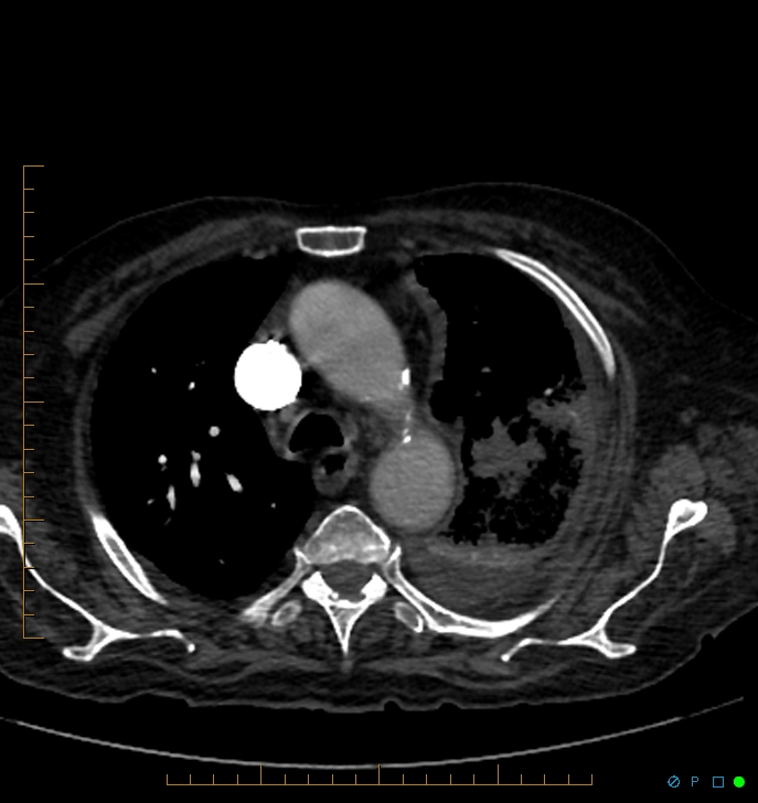 Cavitating pulmonary infarction (Radiopaedia 54634-60849 Axial C+ CTPA 16).jpg