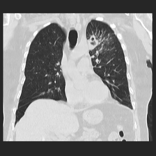 File:Cavitating pulmonary metastases (Radiopaedia 89545-106544 Coronal lung window 18).jpg