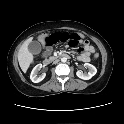 Cecal adenocarcinoma (Radiopaedia 75909-87331 A 40).jpg