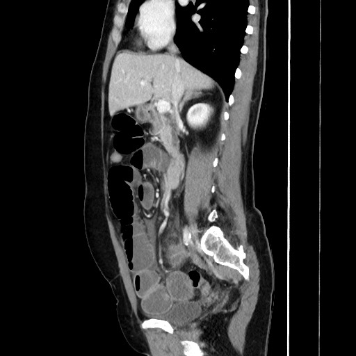 Cecal adenocarcinoma (Radiopaedia 75909-87331 C 32).jpg