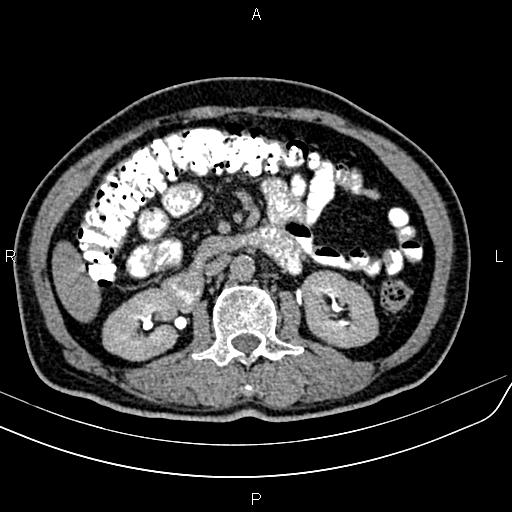 File:Cecal cancer with appendiceal mucocele (Radiopaedia 91080-108651 Axial C+ delayed 26).jpg
