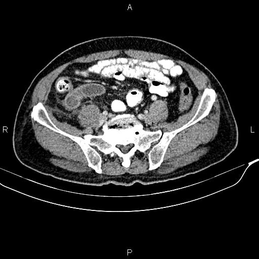 File:Cecal cancer with appendiceal mucocele (Radiopaedia 91080-108651 B 77).jpg
