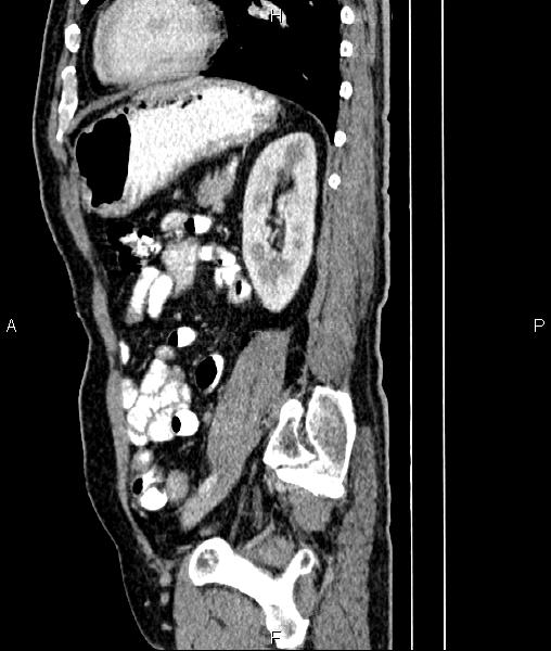 File:Cecal cancer with appendiceal mucocele (Radiopaedia 91080-108651 E 67).jpg