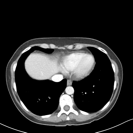 Cecal internal hernia through the foramen of Winslow (Radiopaedia 44820-48651 B 5).png