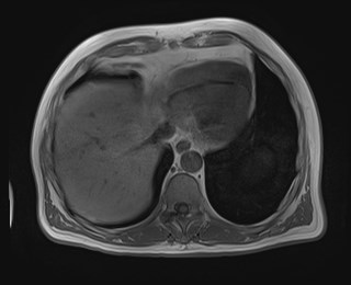 File:Cecal mass causing appendicitis (Radiopaedia 59207-66532 Axial T1 in-phase 23).jpg