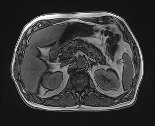 Cecal mass causing appendicitis (Radiopaedia 59207-66532 D 47).jpg