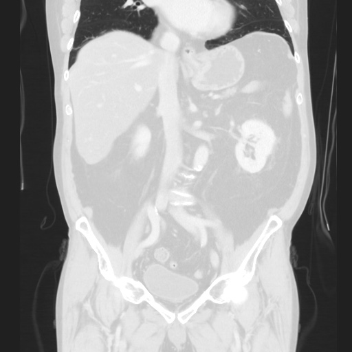 Cecal volvulus (Radiopaedia 75378-86620 Coronal lung window 77).jpg