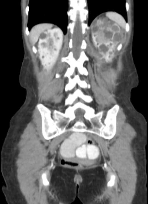 Cecal volvulus with pneumatosis coli (Radiopaedia 68572-78178 B 13).jpg
