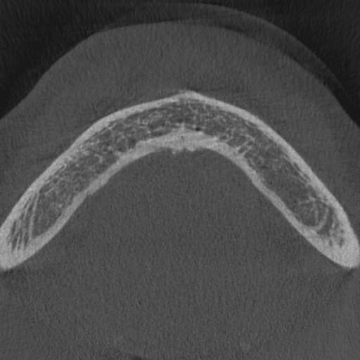 Cemento-osseous dysplasia (Radiopaedia 48251-53126 Axial non-contrast 2).jpg